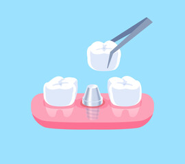 Dental Implant illustration vector design. Dental care concept.