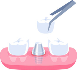 Dental Implant illustration vector design. Dental care concept.