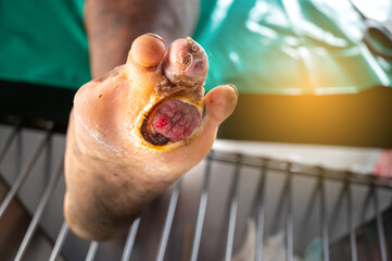 Severe Scab wound infected  in skin on man arm and leg close up.Health care concept.