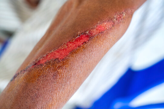 Severe Scab wound infected  in skin on man arm and leg close up.Health care concept.