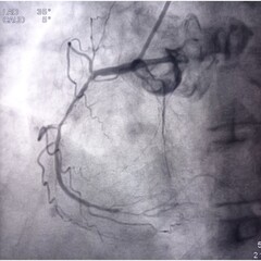 Coronary angiogram of right coronary artery during cardiac catheterization with dye. Findings...