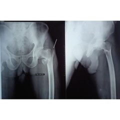 X-rays view of right neck of femur fracture. Bone fracture.