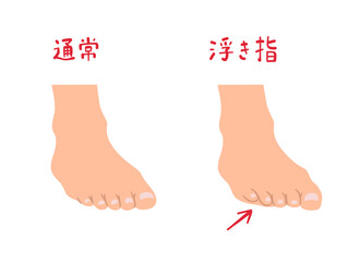 浮き指と通常の足の形の主線なしシンプルイラストセット © yutose