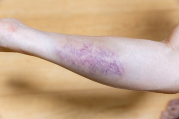 右腕の打撲の青あざ