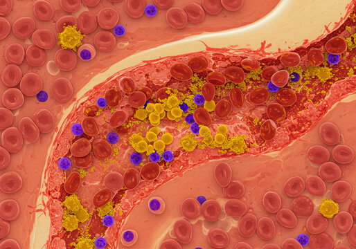 Detailed 3D view of cancerous lymphoblasts, representing acute lymphoblastic leukemia pathology in hematopoiesis