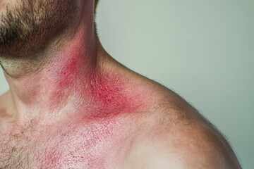 Obraz premium Close-up view of reddened skin on a man's chest and neck.