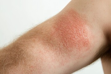 Fototapeta premium Close-up view of skin irritation on an upper arm.