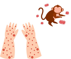 Pustule-covered arms and monkey with virus particles illustration.