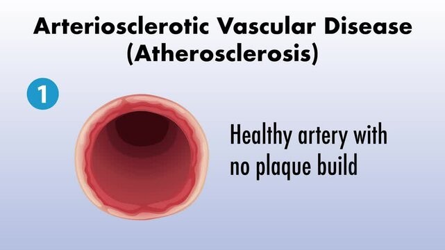 Progression of Arteriosclerotic Vascular Disease