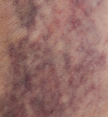 A person's arm with a bruise