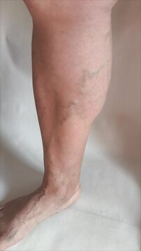 Varicose veins on the legs of a woman in close-up on a white background.  Cardiovascular diseases. Veins on the leg.