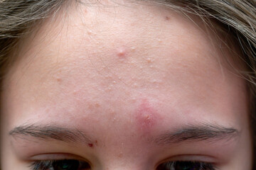 Skin problems. European teen little girl female forehead with acne and pimples. Macro close up shot