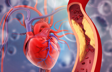 Human heart anatomy with clogged artery. 3d illustration