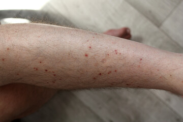 A man's leg was bitten by a midge, there are many traces of mosquito bites, wounds on the leg, areas of skin irritation.
