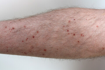 Man's leg covered in midge bites on white background. Allergy and irritation on man's skin.