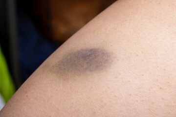 Fototapeta premium A persons arm that features a noticeable purple spot on it
