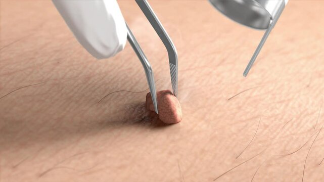 Skin surface with papilloma laser removal treatment macro, looped switch