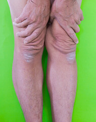 body parts Calluses and rough skin on legs and knees. of the elderly with muscle inflammation and bone degene.