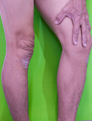 body parts Calluses and rough skin on legs and knees. of the elderly with muscle inflammation and bone degene.
