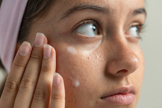 Macro of a woman applying a treatment for milia or clogged pores under her eyes