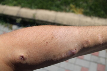 Detailed image showing a small patch of skin and needle marks on a persons arm.