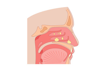 Nasal Polyps poster