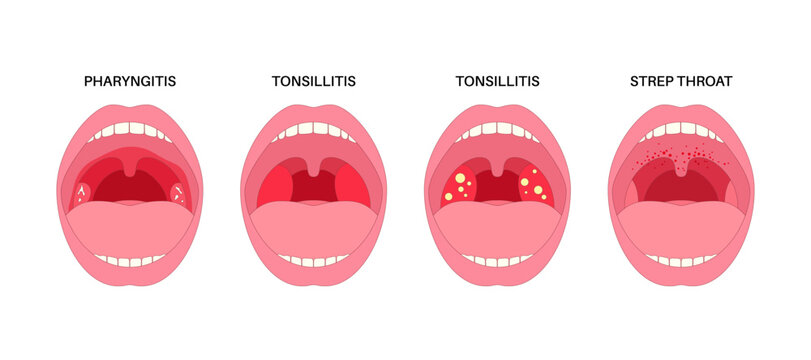 Pharyngotonsillitis oral disease