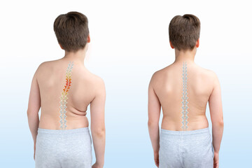 Child's back showing spinal curvature comparison, scoliosis pain, kyphosis, before and after,...