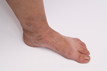 Early varicose symptoms include mild vein bulging, heaviness and skin discoloration on foot area,...