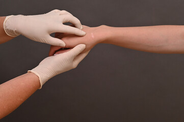 Linear scar visible on wrist after cyst surgery. typical healing process of soft tissue following...