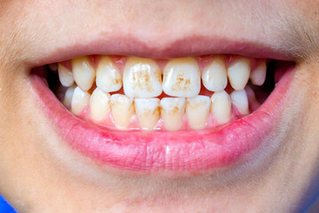 Dark plaque on children's teeth. Priestley's raid. Dental health concept. Oral care. Pediatric...