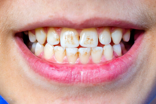 Dark plaque on children's teeth. Priestley's raid. Dental health concept. Oral care. Pediatric dentistry and periodontology. Dark spots on teeth