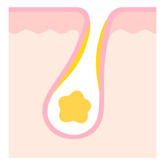 角栓の詰まった毛穴　断面図