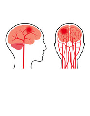 Brain Pain and Headache Diagram: Understanding Cerebral Discomfort