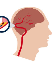 Brain Blood Clot and Stroke Diagram: Cerebral Artery Blockage