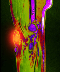 The MRI scan reveals a lipoma lesion in the elbow joint, highlighted by the red area. The soft tissue mass appears distinct from surrounding structures.