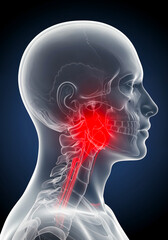 Chronic sinusitis with throat inflammation shown in 3D transparent head anatomy
