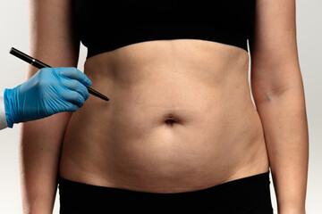 Preparing for Cosmetic Surgery with Markings on Abdomen