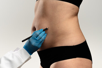 Preparing for Cosmetic Surgery with Markings on Abdomen