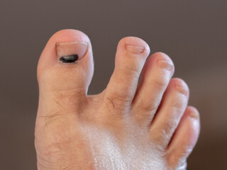 Close up of a toe with a bruise under the nail indicating a possible injury or contusion reflecting...