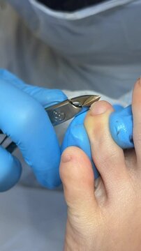 Close-up nail clipping one healthy, one fungal-infected, showing contrasting conditions