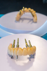 implant dentaire, dentier sur pivot dans un laboratoire d'implantologie