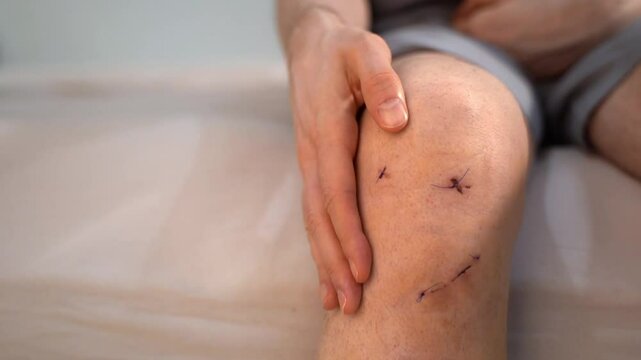 Close-up of man calmly touching knee with stitches on wound after ACL surgery. Concept of gentle reassurance, body awareness, optimistic approach to recovery following orthopedic sports-related trauma