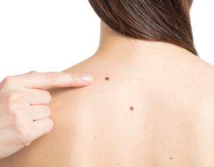 A person points at a mole on the upper back, highlighting skin marks against a plain background.