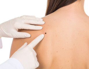 A medical professional wearing gloves examines a mole on a person's bare back, highlighting skin health and dermatological care.