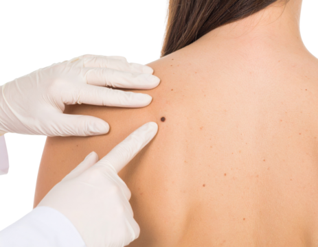 A medical professional wearing gloves examines a mole on a person's bare back, highlighting skin health and dermatological care.