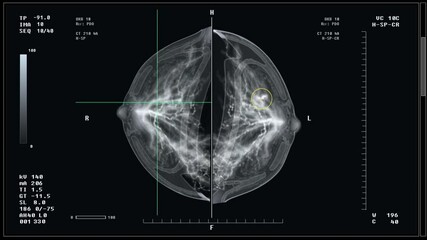 Diagnostic imaging test at the healthcare hospital. Diagnostic imaging test of the female patients breast. Diagnostic mammography imaging test for early detection of breast cancer. Mastography.