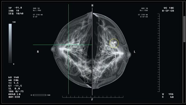 Diagnostic imaging test at the healthcare hospital. Diagnostic imaging test of the female patients breast. Diagnostic mammography imaging test for early detection of breast cancer. Mastography.