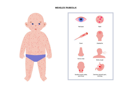 Measles or rubeola symptoms.
