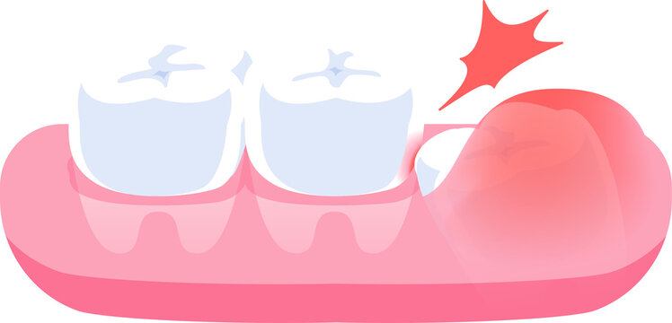 Impacted wisdom tooth illustration design. Dental care concept.